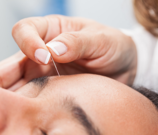 Facial Acupuncture Treatment